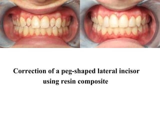 Correction of a peg-shaped lateral incisor
using resin composite
 