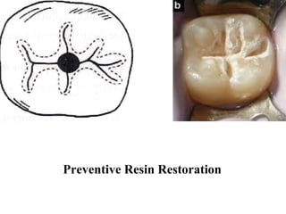 Preventive Resin Restoration
 