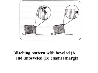 Etching pattern with beveled (A(
and unbeveled (B( enamel margin
 