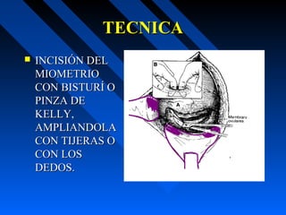 TECNICATECNICA
 INCISIÓN DELINCISIÓN DEL
MIOMETRIOMIOMETRIO
CON BISTURÍ OCON BISTURÍ O
PINZA DEPINZA DE
KELLY,KELLY,
AMPLIANDOLAAMPLIANDOLA
CON TIJERAS OCON TIJERAS O
CON LOSCON LOS
DEDOS.DEDOS.
 