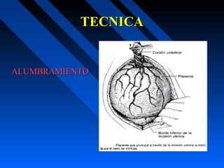 TECNICATECNICA
ALUMBRAMIENTOALUMBRAMIENTO
 