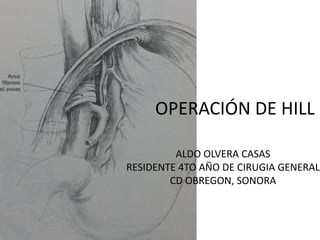 OPERACIÓN DE HILL
ALDO OLVERA CASAS
RESIDENTE 4TO AÑO DE CIRUGIA GENERAL
CD OBREGON, SONORA
 