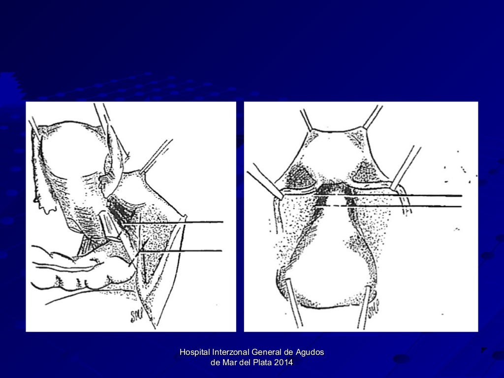 Operación Wertheim Meigs en cancer de cuello uterino