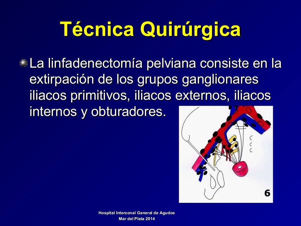 Operación Wertheim Meigs en cancer de cuello uterino