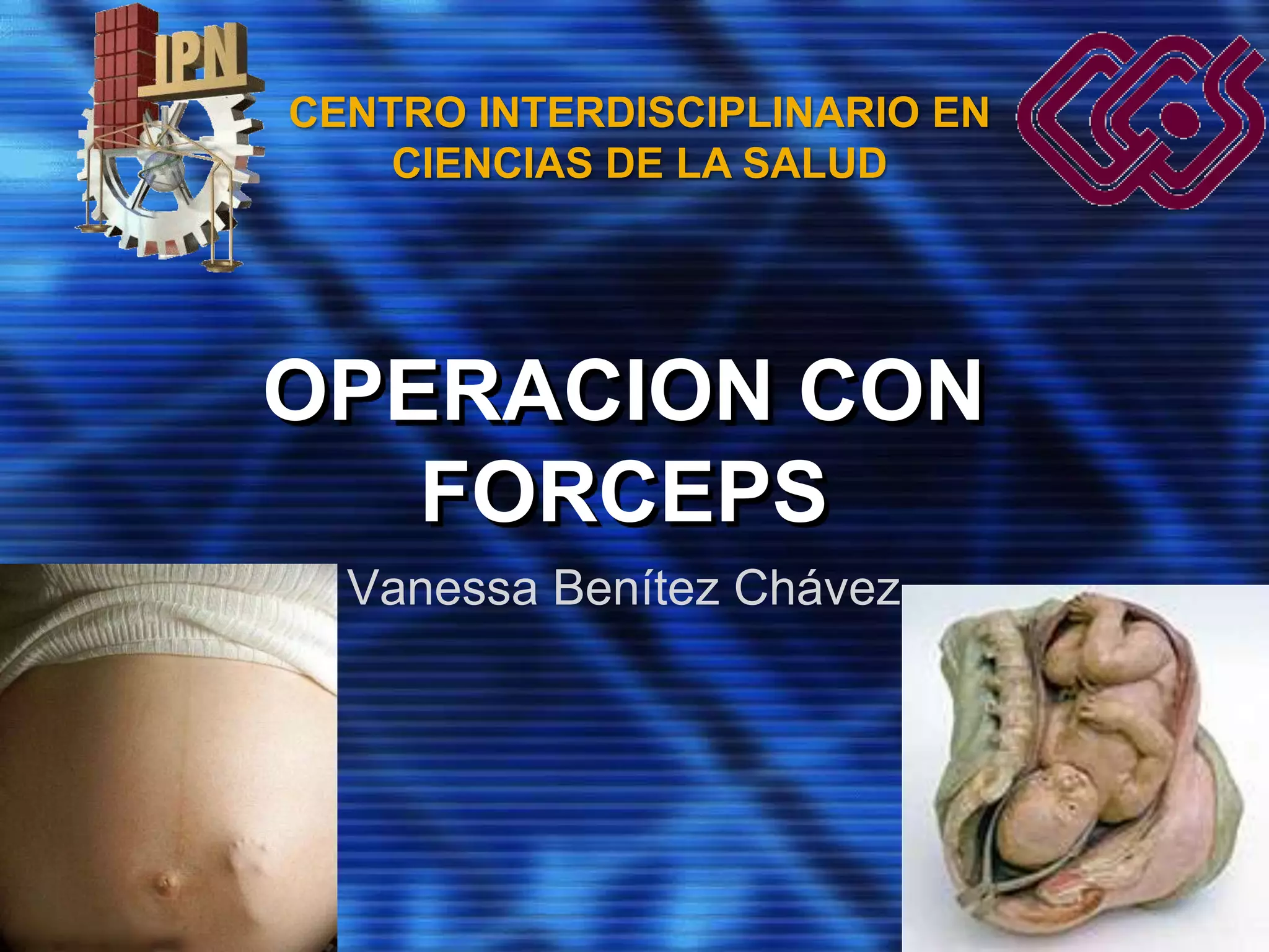 Operacion Con Forceps