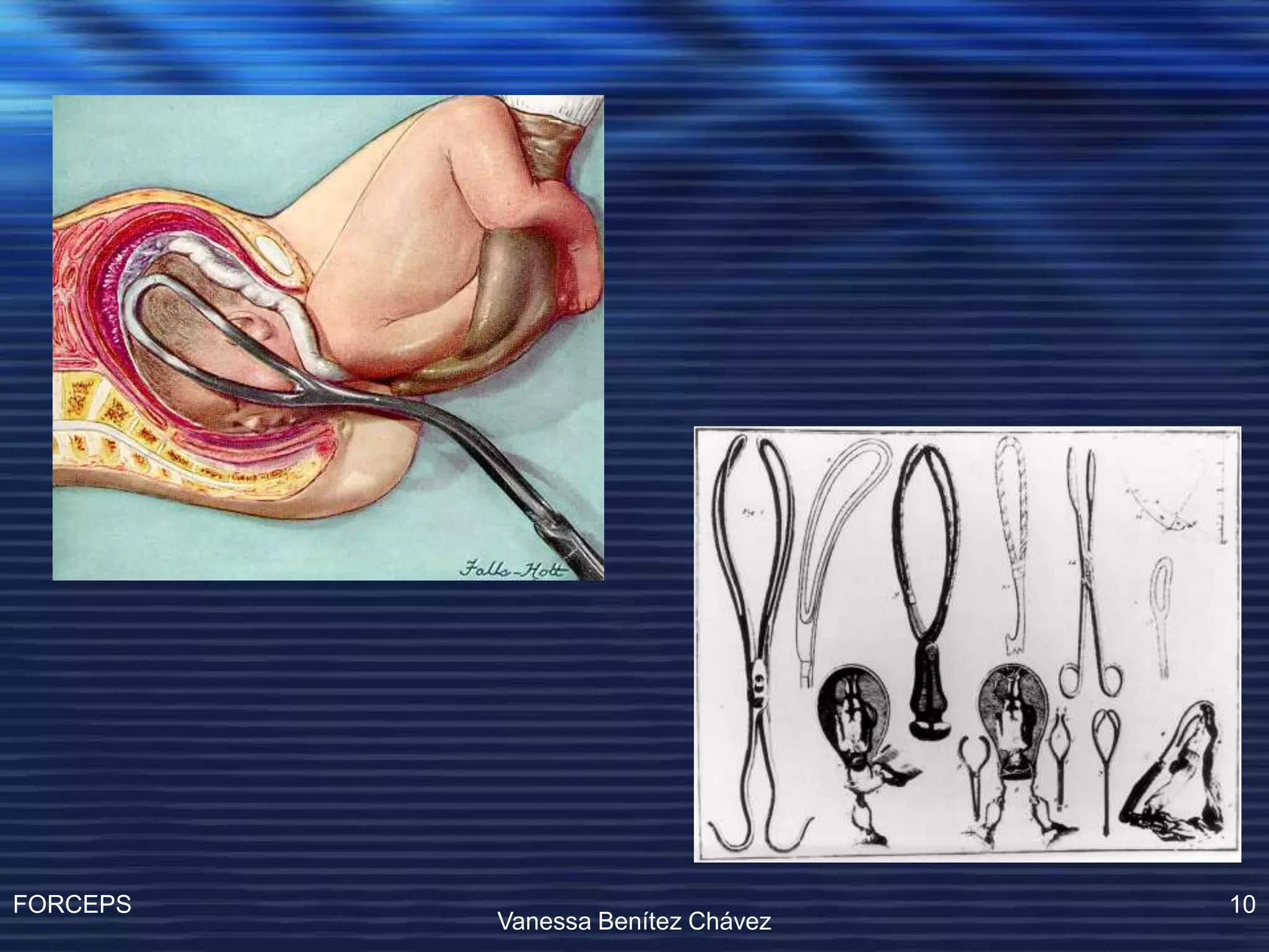 Operacion Con Forceps