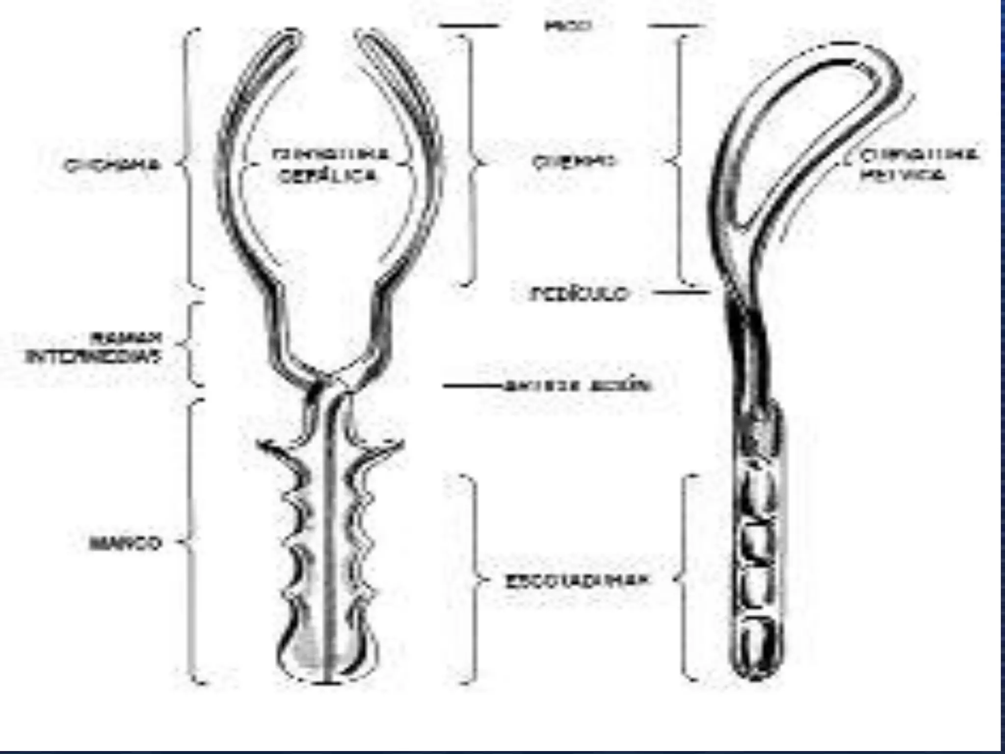 Operacion Con Forceps