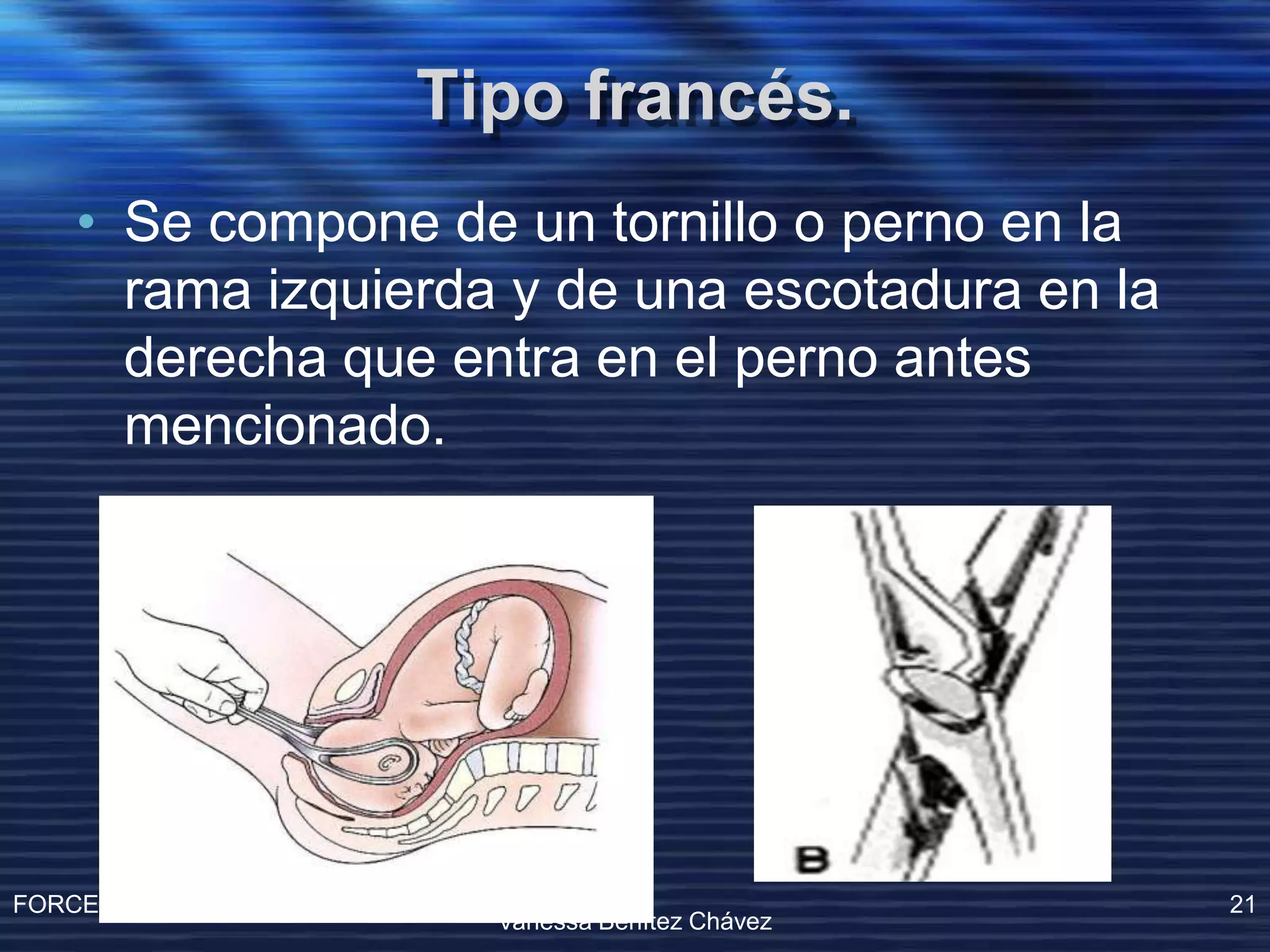 Operacion Con Forceps