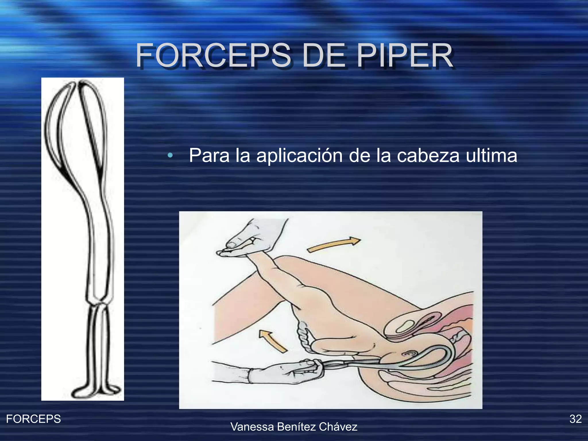 Operacion Con Forceps