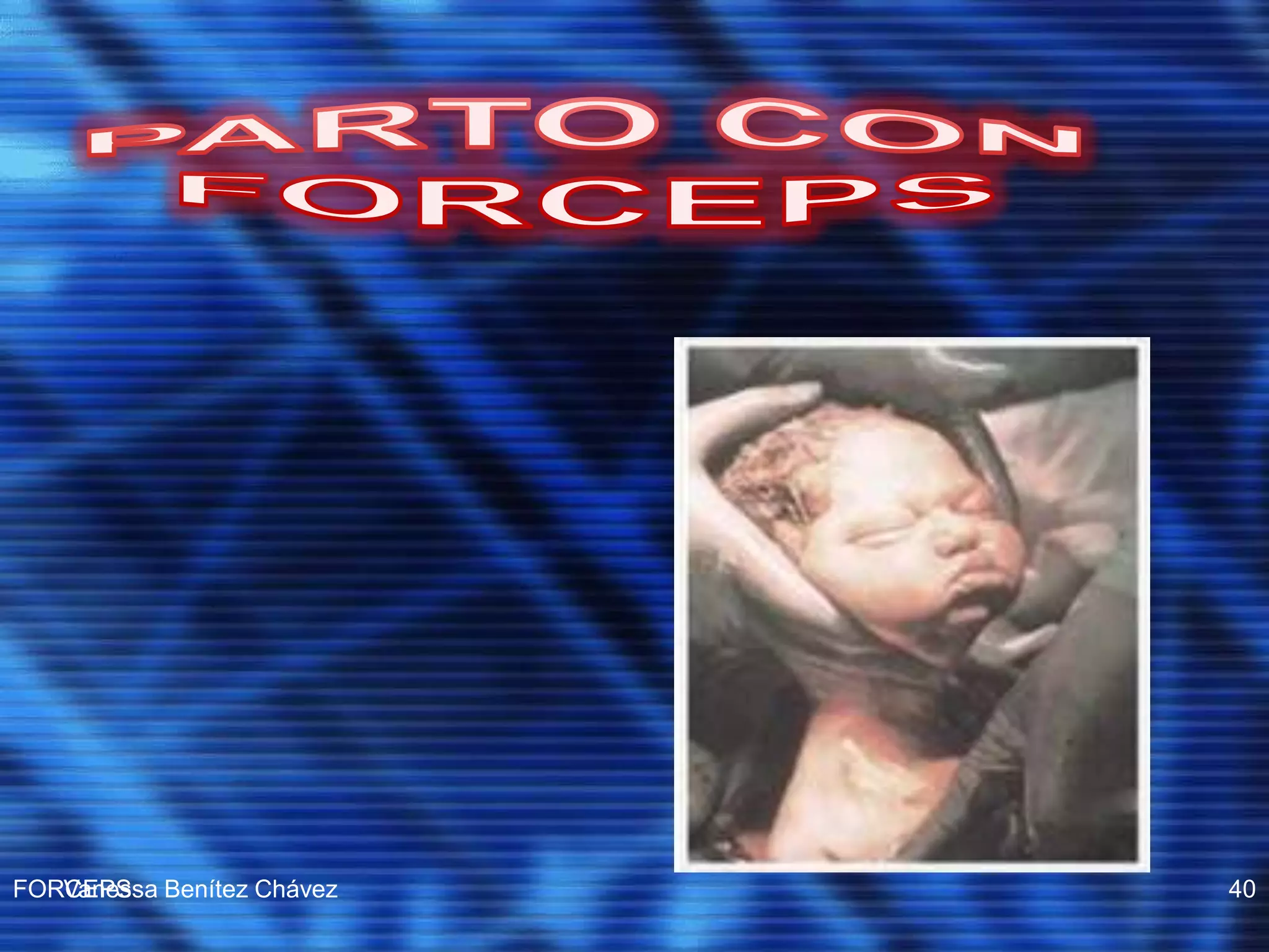 Operacion Con Forceps