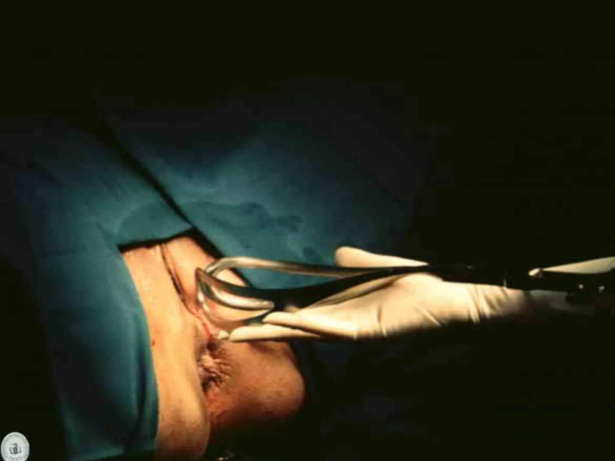 Operacion Con Forceps