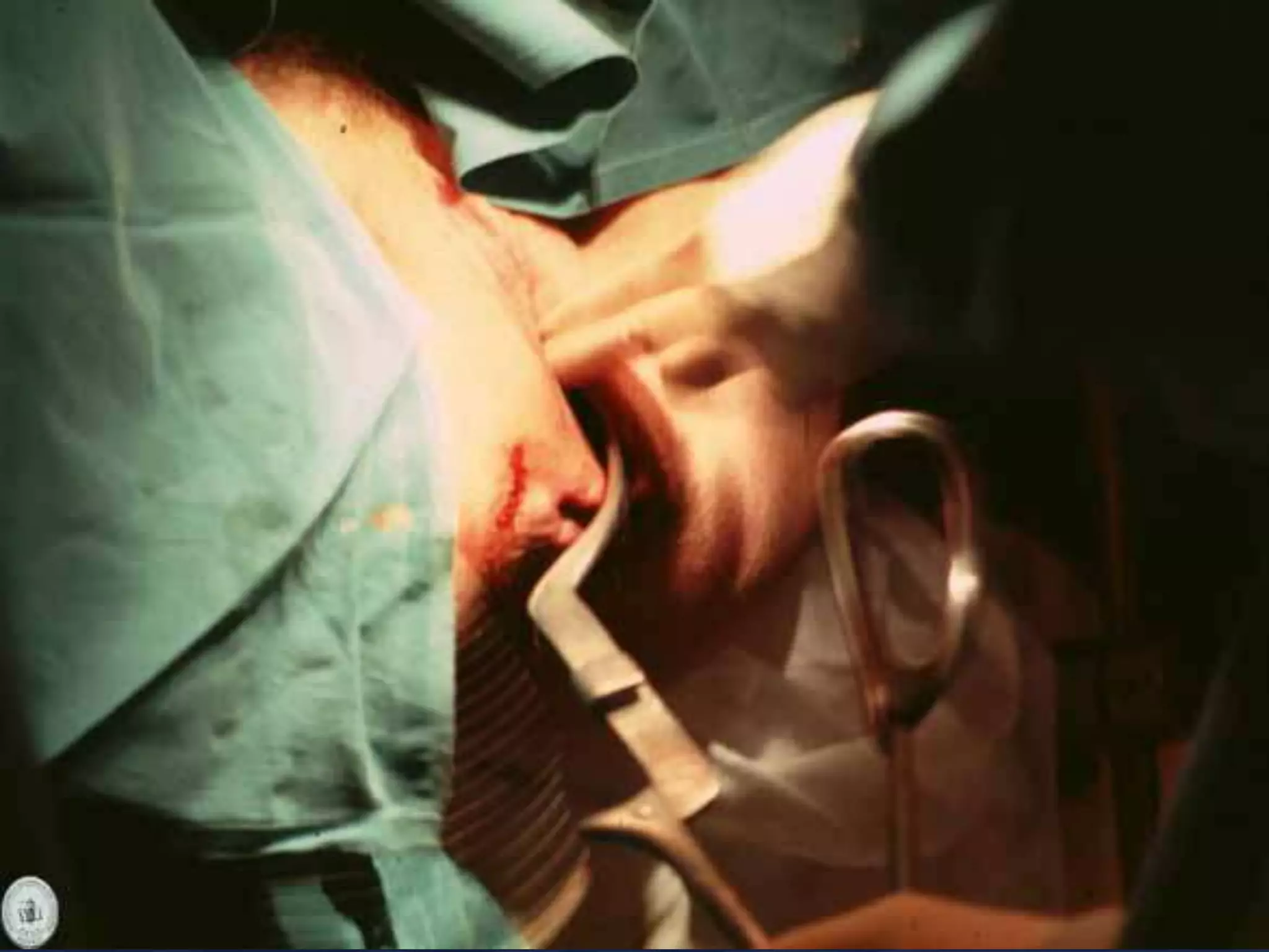 Operacion Con Forceps