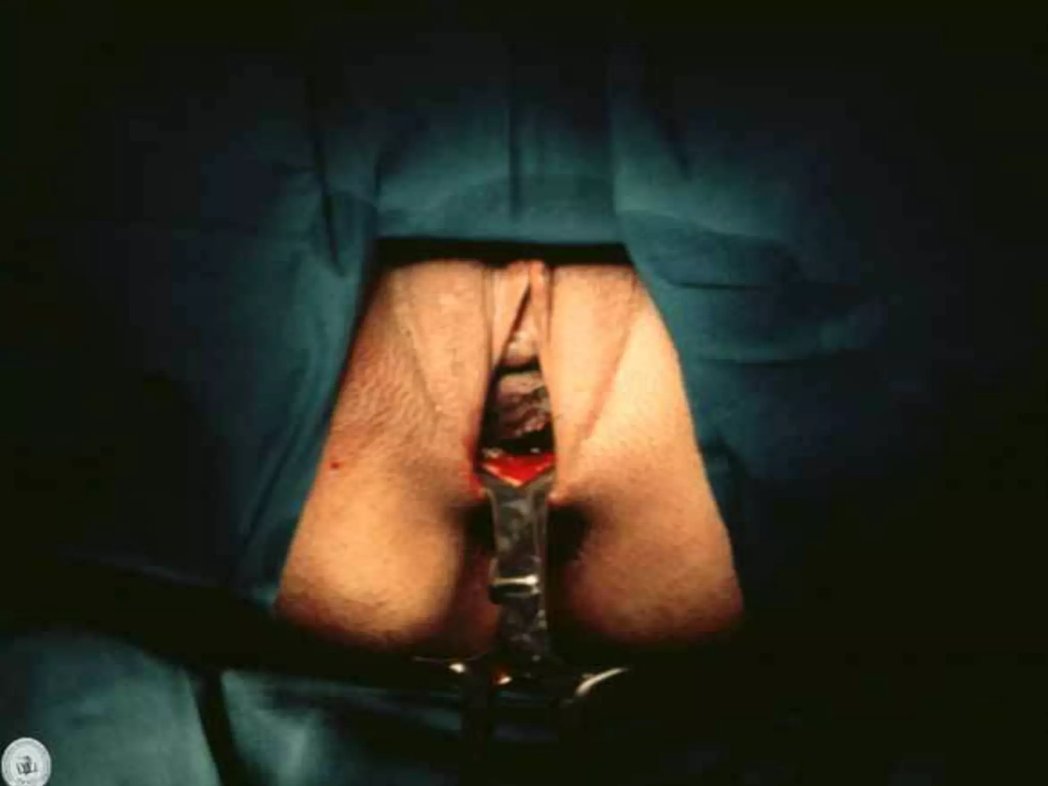 Operacion Con Forceps