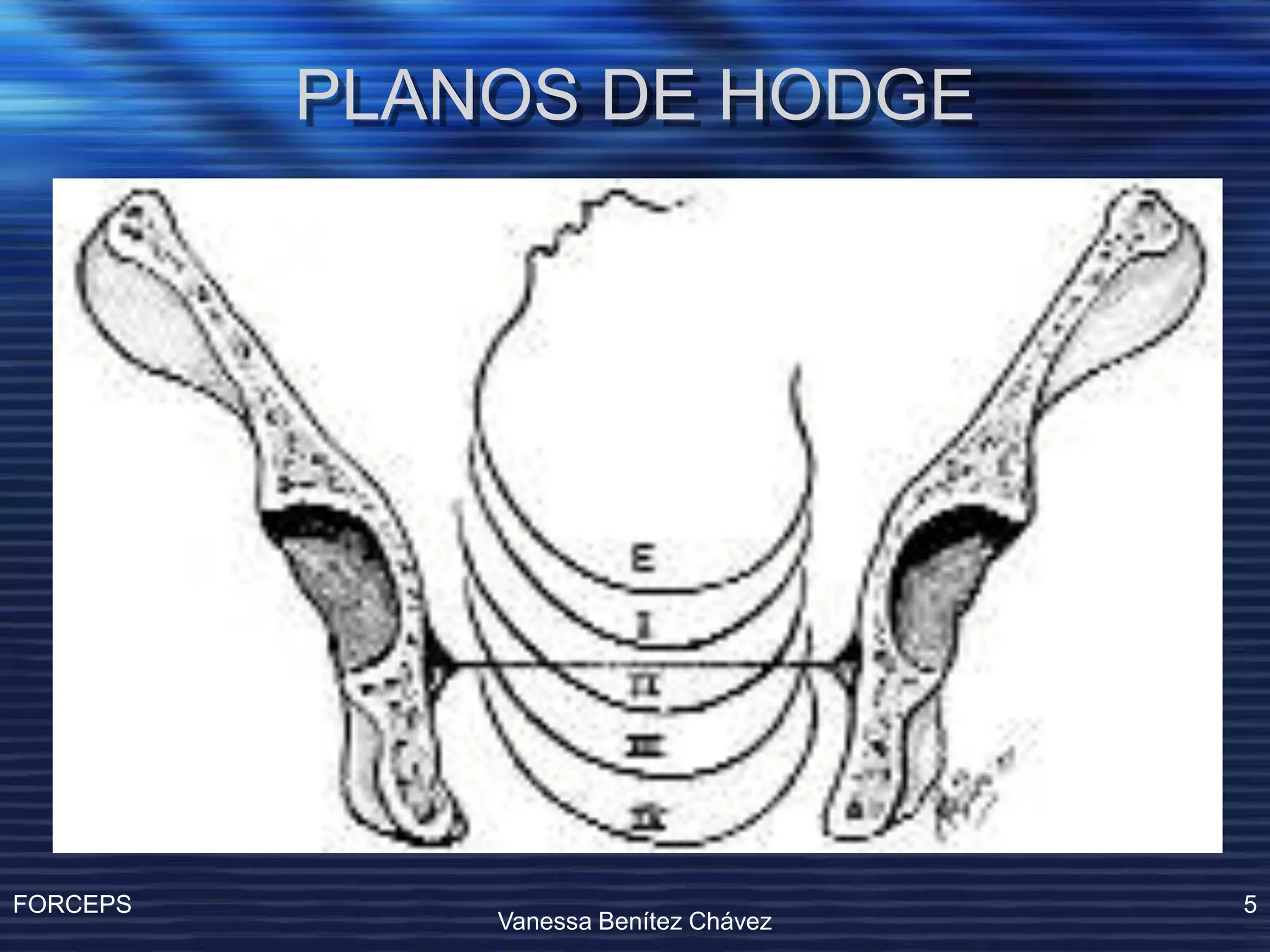 Operacion Con Forceps