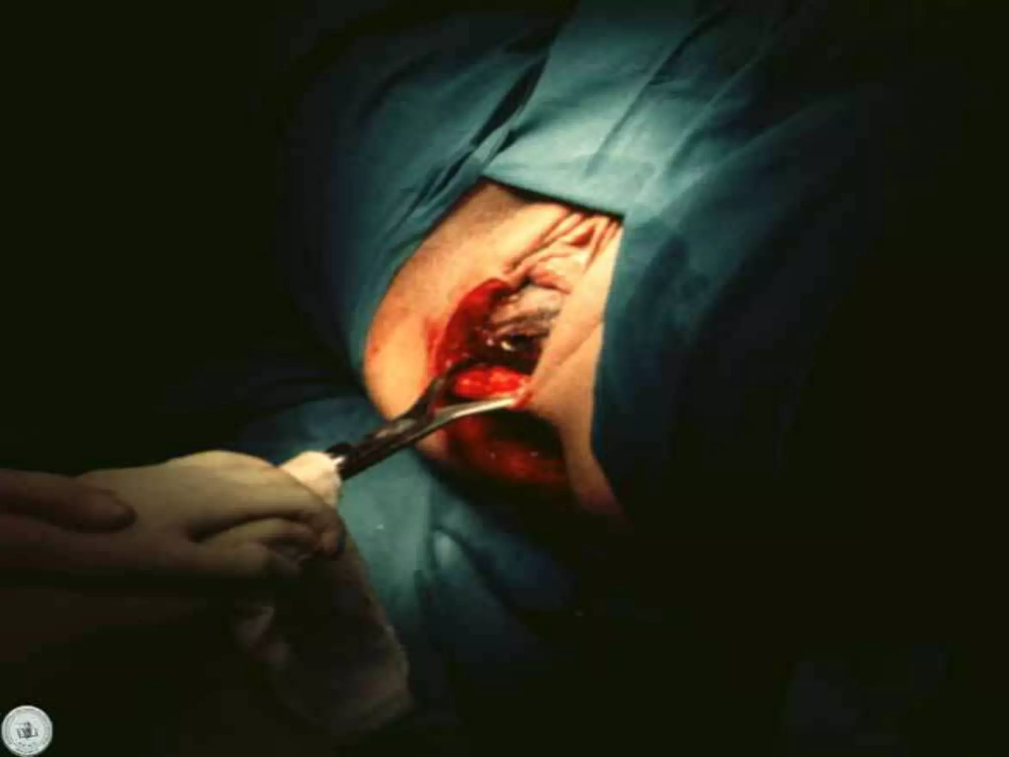 Operacion Con Forceps