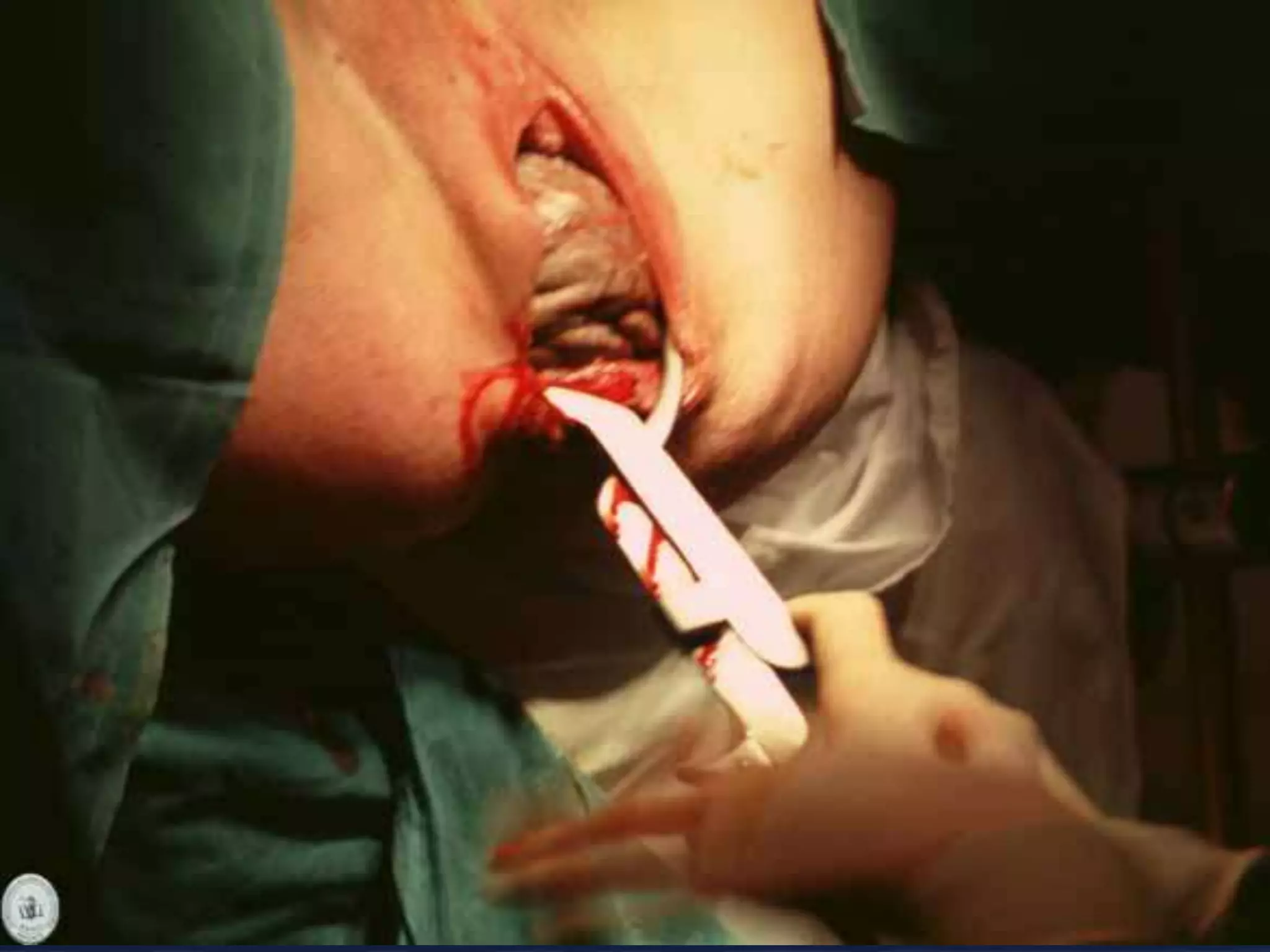 Operacion Con Forceps