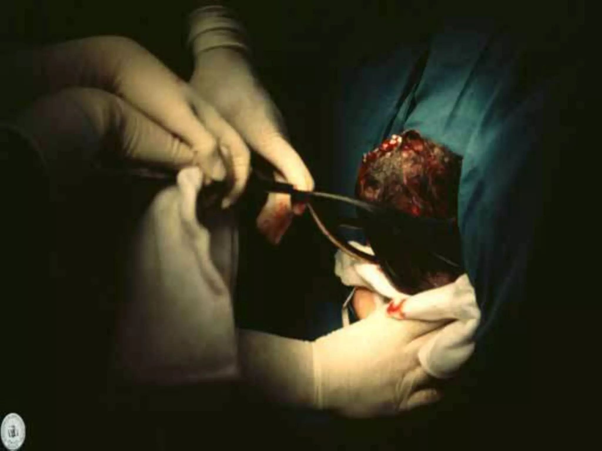 Operacion Con Forceps