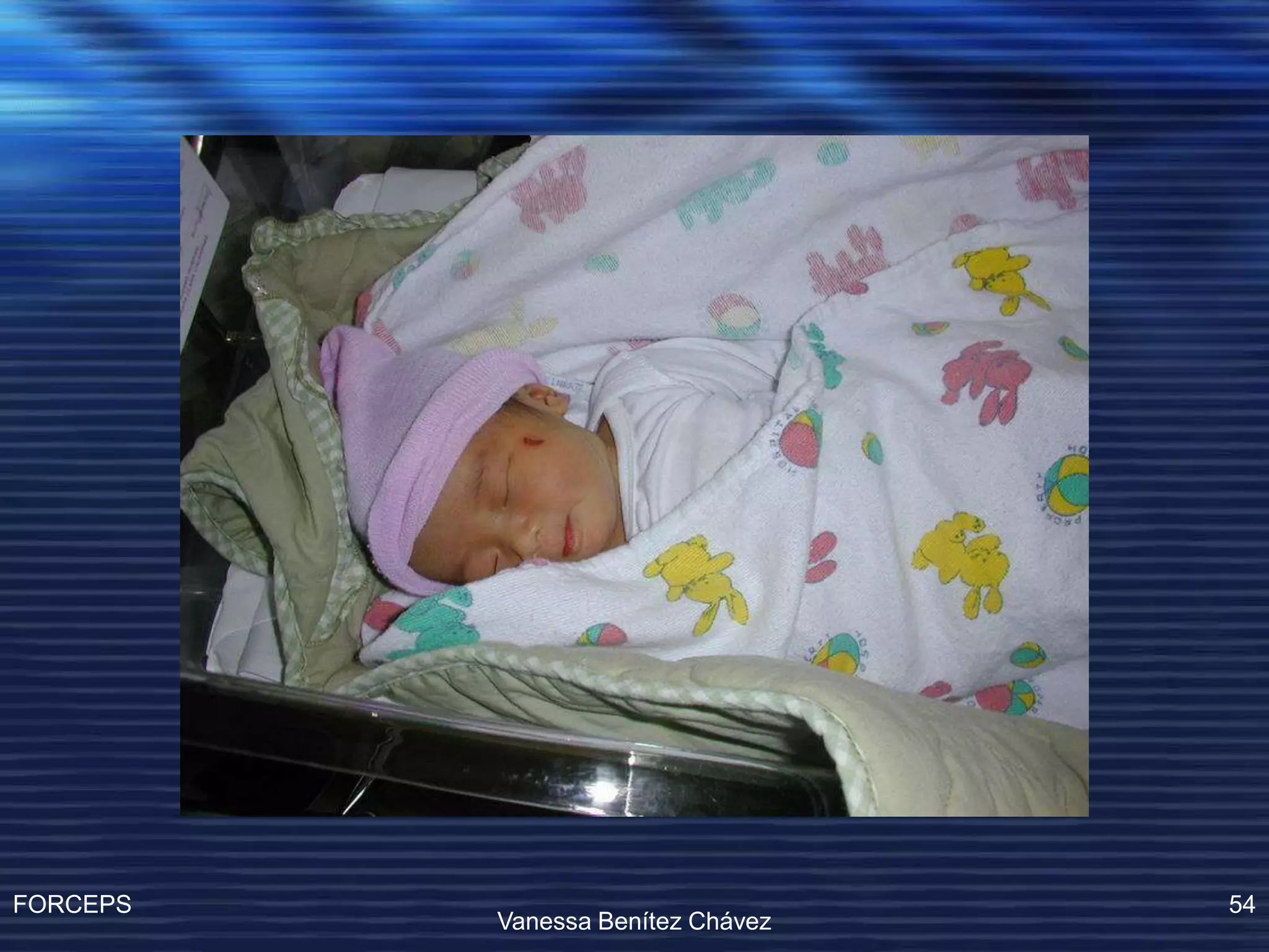 Operacion Con Forceps