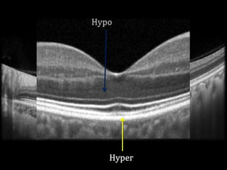 Normal Oct Mves Operating an OCT & evaluating normal scan (Optom.Saptarshi Mehta ...