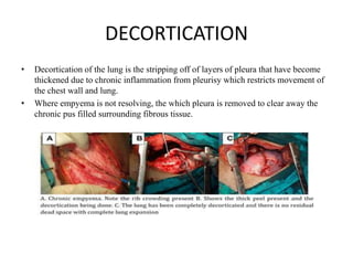 Operation on the pleura