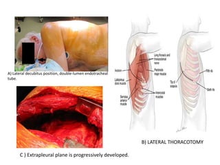 Operation on the pleura