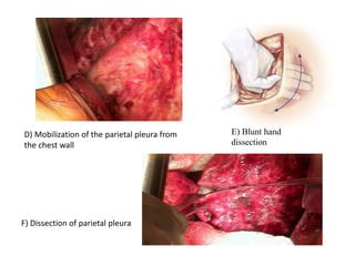 Operation on the pleura