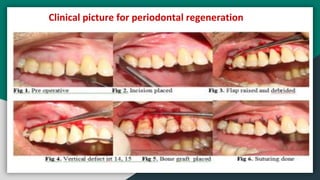 Clinical picture for periodontal regeneration
 