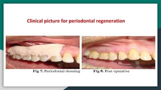 Clinical picture for periodontal regeneration
 