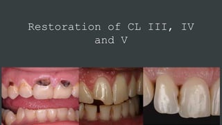 Restoration of CL III, IV
and V
 