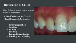 Restoration of CL III
Class III- Smooth surface, involves proximal
surface of anterior tooth.
Clinical Technique for Class III
Direct Composite Restoration
- Cavity preparation
- Isolation
- Etching
- Bonding
- Composite application
- Finishing and polishing
 