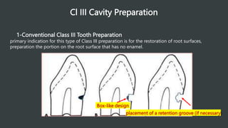 Cl III Cavity Preparation
1-Conventional Class III Tooth Preparation
primary indication for this type of Class III preparation is for the restoration of root surfaces,
preparation the portion on the root surface that has no enamel.
Box-like design
placement of a retention groove (if necessary)
 