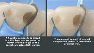 A flowable composite is placed
in a thin layer and we press the
matrix with the finger on the
buccal side before light-curing.
Then, a small amount of enamel
composite is placed to restore the
proximal wall.
 