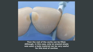 Then the rest of the cavity can be filled.
Although, in this case, only an enamel shade
was used, a body material can be very useful
for this kind of cavities
 