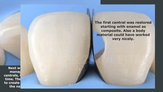 Next we go with the centrals. For a good
management of the space between the
centrals, two matrices are placed at the same
time. The position is very important in order
to create a restoration as close as possible to
the natural shape of the proximal area.
The first central was restored
starting with enamel as
composite. Also a body
material could have worked
very nicely.
 