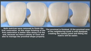 Both matrices were removed to finish the
first restoration. At this stage finishing of the
first restoration is better than doing it at the
end, because we have a plenty of room and
also to manage the proximal shape properly.
The proximal is finished. If the proximal area
of the neighboring tooth is well designed,
creating the contact point and fitting the
matrix will be easier.
 