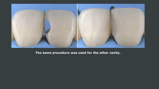 The same procedure was used for the other cavity.
 