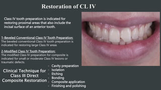 Restoration of CL IV
Class IV tooth preparation is indicated for
restoring proximal areas that also include the
incisal surface of an anterior tooth.
1-Beveled Conventional Class IV Tooth Preparation:
The beveled conventional Class IV tooth preparation is
indicated for restoring large Class IV areas
2-Modified Class IV Tooth Preparation:
The modified Class IV preparation for composite is
indicated for small or moderate Class IV lesions or
traumatic defects.
Clinical Technique for
Class III Direct
Composite Restoration
- Cavity preparation
- Isolation
- Etching
- Bonding
- Composite application
- Finishing and polishing
 