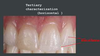 Tertiary
characterization
(horizontal )
lines of Retzius
 