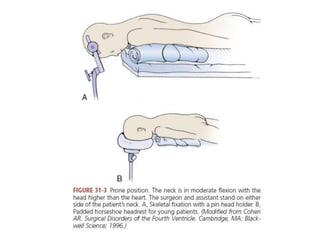 Operative approaches for 4th ventricular tumours | PPTX