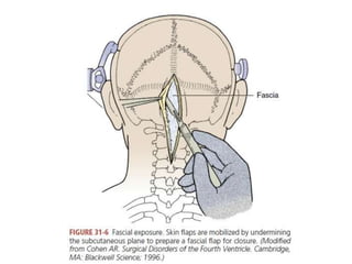Oprative Approach Operative approaches for 4th ventricular tumours | PPTX | Death, Injury ...