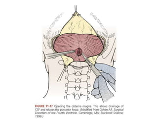 Oprative Approach Operative approaches for 4th ventricular tumours | PPTX