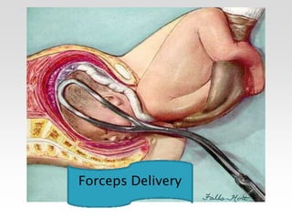 Forceps Delivery
 