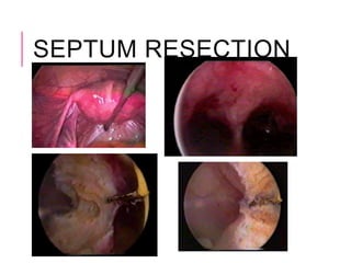 SEPTUM RESECTION
 