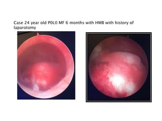 Case 24 year old P0L0 MF 6 months with HMB with history of
laparotomy
 