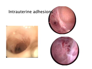 Intrauterine adhesions
 