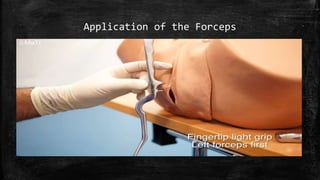 Application of the Forceps
 