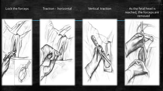 Lock the forceps Traction - horizontal Vertical traction As the fetal head is
reached, the forceps are
removed
 