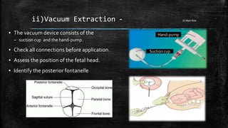 ii)Vacuum Extraction - Dr.Mani Smk
▪ The vacuum device consists of the
– suction cup and the hand-pump.
▪ Check all connections before application.
▪ Assess the position of the fetal head.
▪ Identify the posterior fontanelle
Suction cup
Hand-pump
 