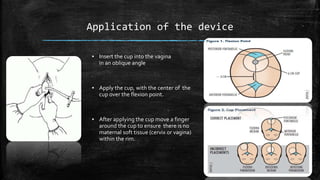 Application of the device
▪ Insert the cup into the vagina
in an oblique angle
▪ Apply the cup, with the center of the
cup over the flexion point.
▪ After applying the cup move a finger
around the cup to ensure there is no
maternal soft tissue (cervix or vagina)
within the rim.
 