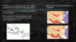 ▪ With the pump, create a vacuum of 0.2 kg/cm2
negative pressure and check the application.
▪ Increase the vacuum to 0.8 kg/cm2 and check
the application.
▪ After maximum negative pressure, start
traction in the line of the pelvic axis and
perpendicular to the cup.
▪ Remove the cup when the fetal jaw is
reachable.
 